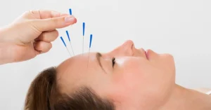 Consider trying acupuncture